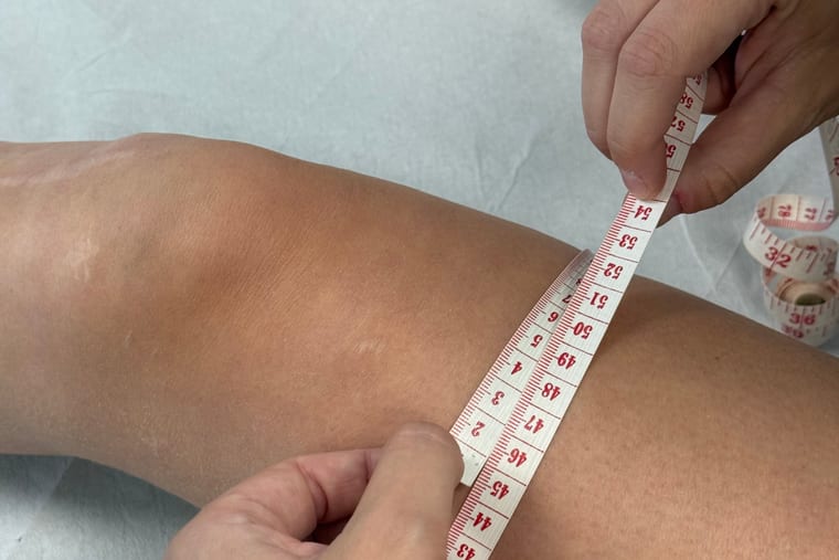 Merjenje obsega stegna s šiviljskim trakom pred operacijo križne vezi